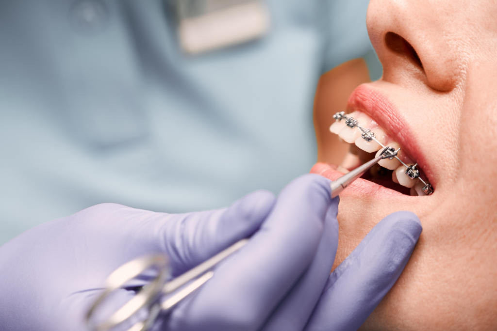 BRACKETS en Valencia - Dentistas Valencia