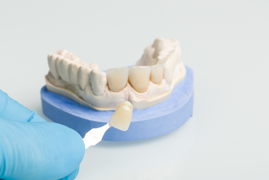 CARILLAS DENTALES en Valencia - Dentistas Valencia
