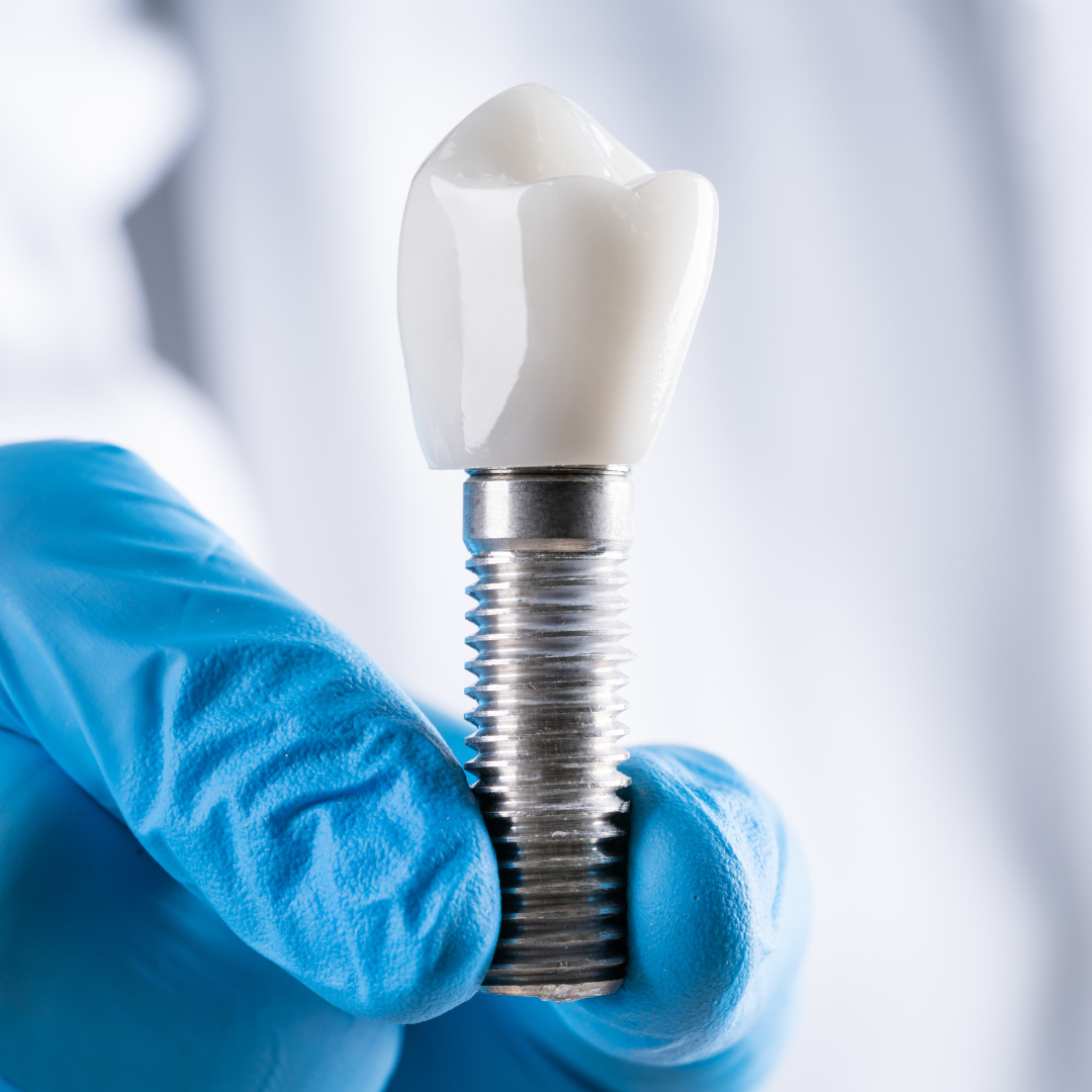 IMPLANTES DENTALES en Valencia - Dentistas Valencia